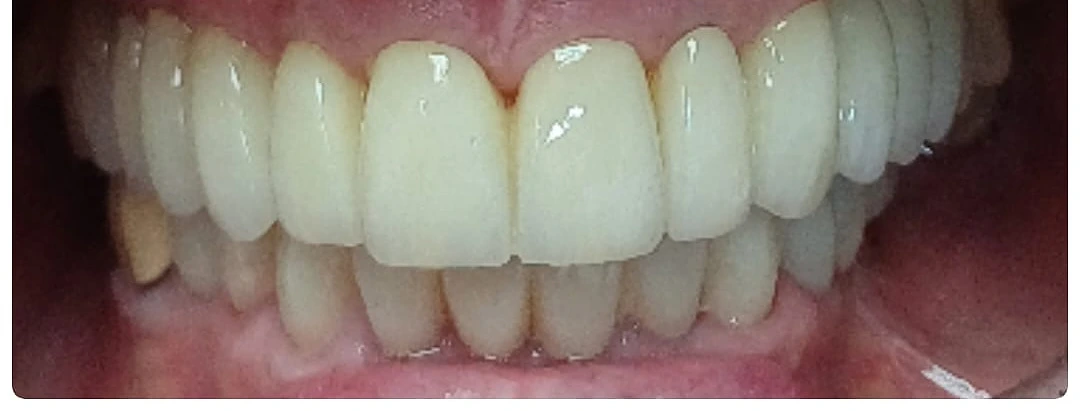 Sonrisa tras rehabilitación con coronas de porcelana — Dental Estetic Oeste